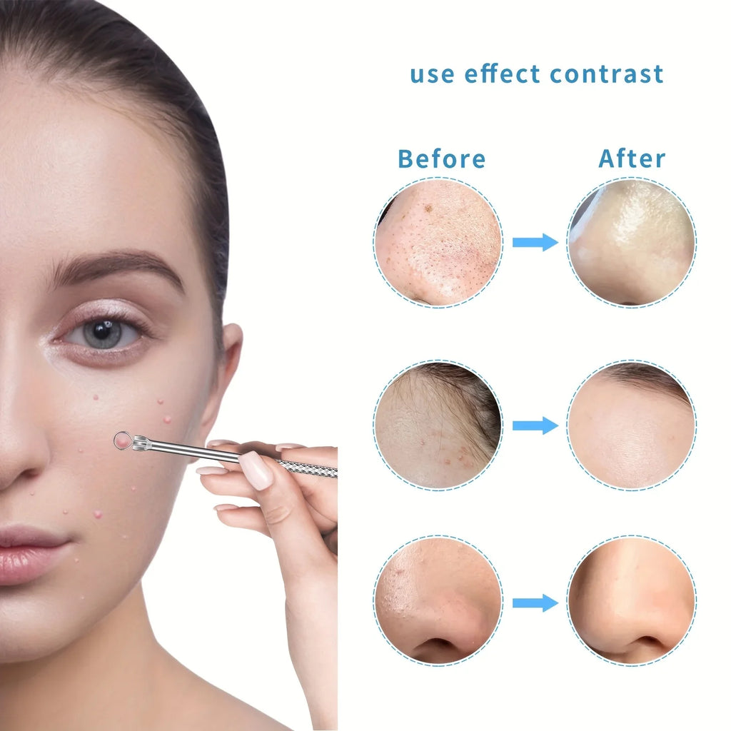 15pcs Facial Cleansing Beauty Tool Set Stainless Steel Pliers Cell Clips,Comedone Extractor,Blackhead and Whitehead Removal Tool