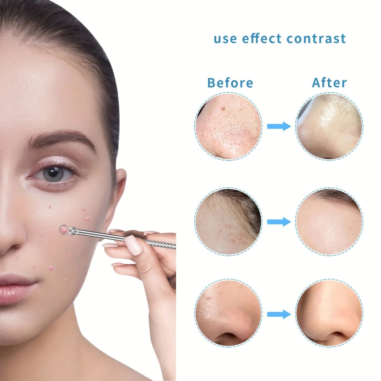 15pcs Facial Cleansing Beauty Tool Set Stainless Steel Pliers Cell Clips,Comedone Extractor,Blackhead and Whitehead Removal Tool