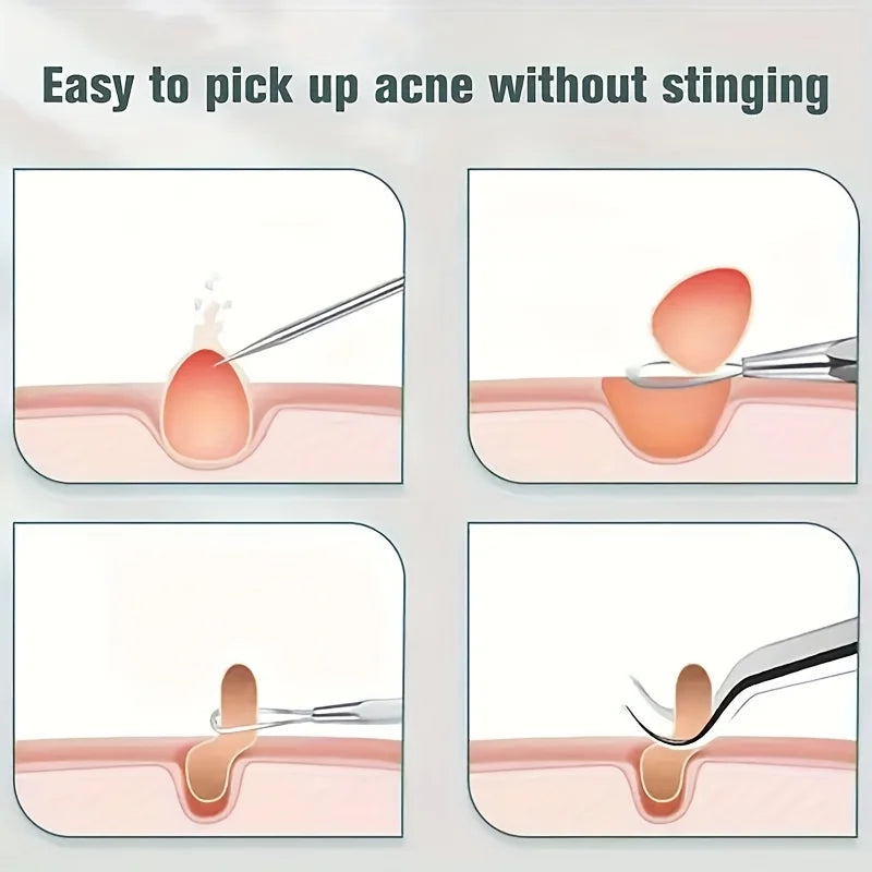 15pcs Facial Cleansing Beauty Tool Set Stainless Steel Pliers Cell Clips,Comedone Extractor,Blackhead and Whitehead Removal Tool